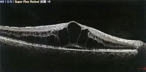 黄斑浮腫 網膜中心に浮腫ができ、視力が低下します。